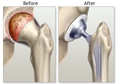 TotalHipReplacement_-_Before__After